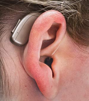 Ear wearing receiver-in-the-ear (RITE) type of hearing aid.