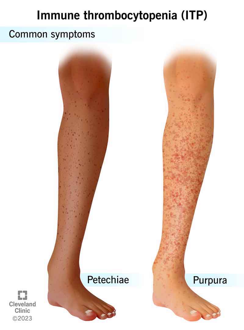 mild idiopathic thrombocytopenic purpura