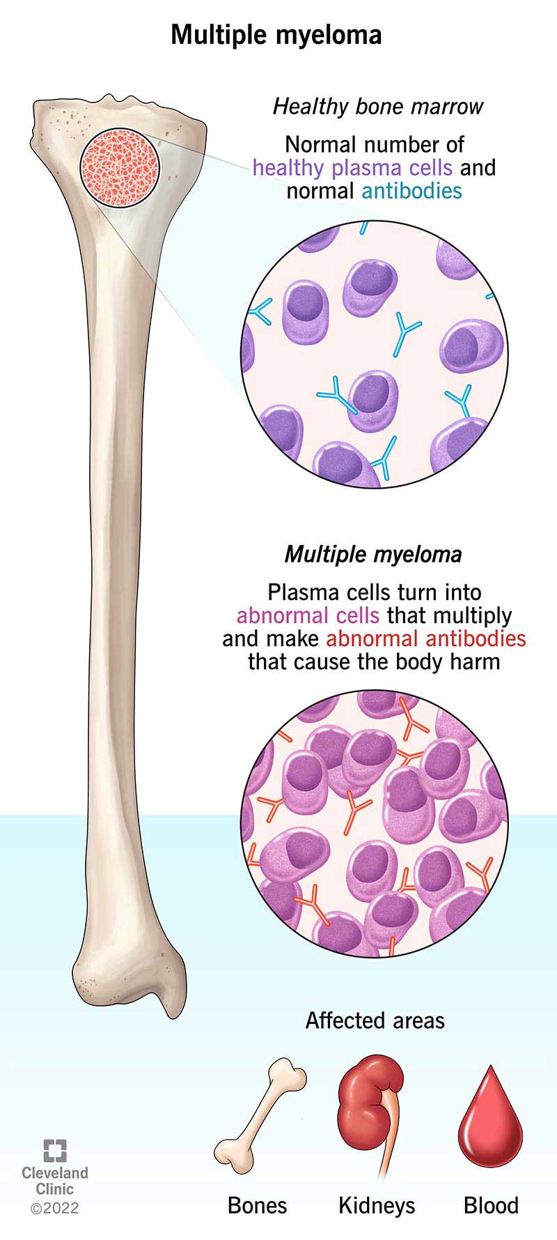 The abnormal plasma cells also create abnormal antibodies, called M proteins, that can cause heart and kidney issues.