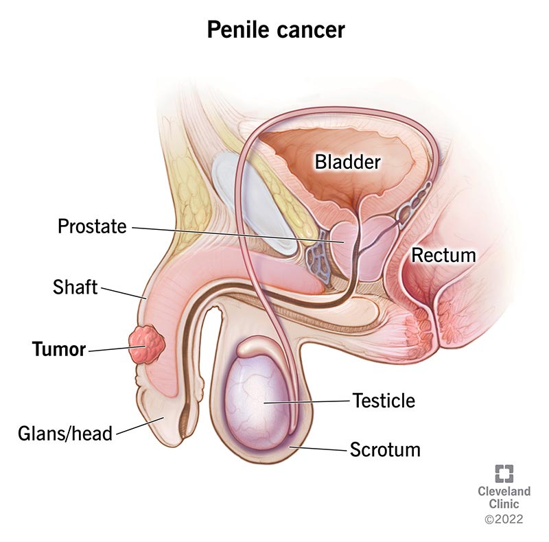 A tumor that’s formed on the shaft of the penis near the glans/head.