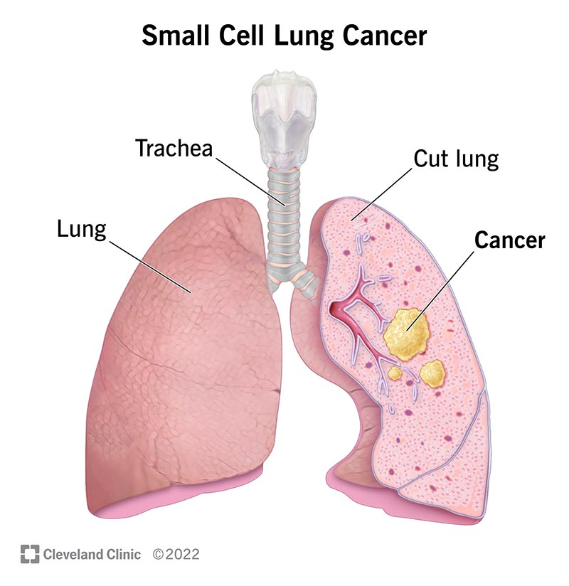 (Left) Exterior view of lung. (Right) Lung cut in half to show small cell lung cancer tumors.