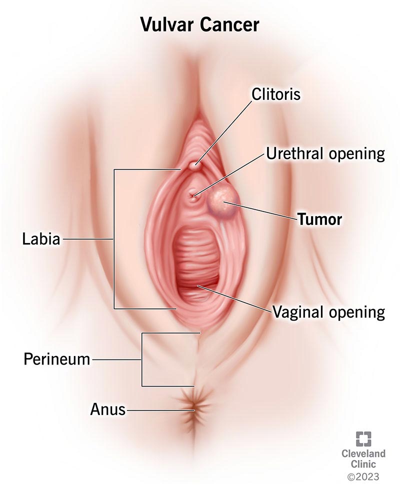A tumor that’s formed near the urethral opening on the labia minora.