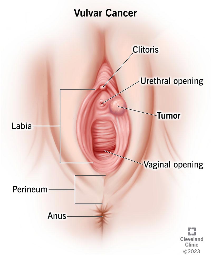 Vulvar Cancer Symptoms, Causes and Treatment