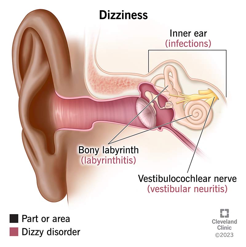 Inner ear disorders that can cause dizziness include inner ear infections (top right), labyrinthitis (center ) and vestibular neuritis (middle right).