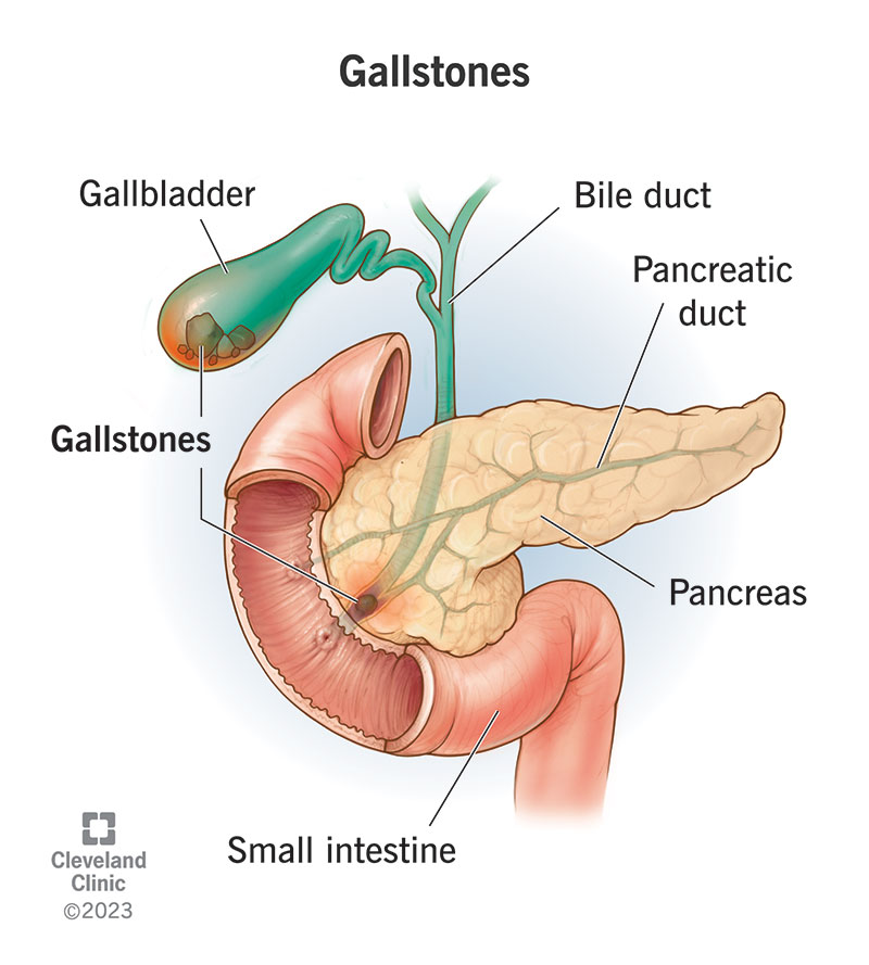 Gallstones the gallbladder, along with small intestine and pancreas