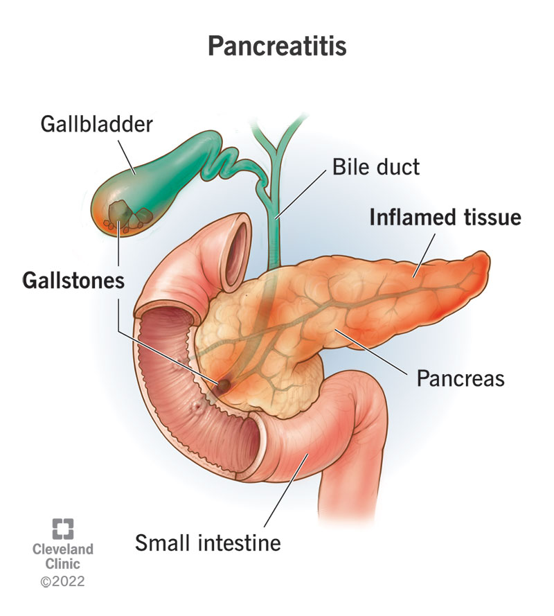 Gallstones blocking the pancreatic duct can cause pancreatitis.