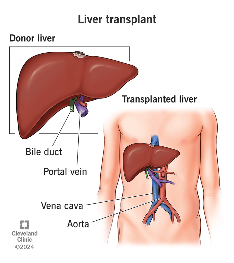 In a liver transplant, a donor liver (inset) connects to your portal vein (left) and vena cava (right) to replace your liver.