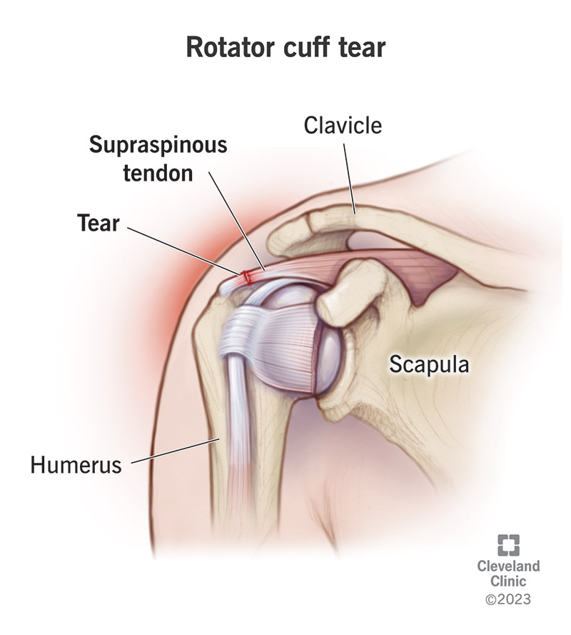 A rotator cuff tear affects the muscles and tendons of your shoulder.