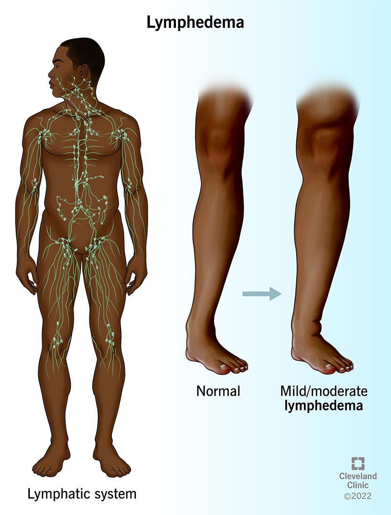 Lower leg without lymphedema (center) and lower leg with mild/moderate lymphedema (right).