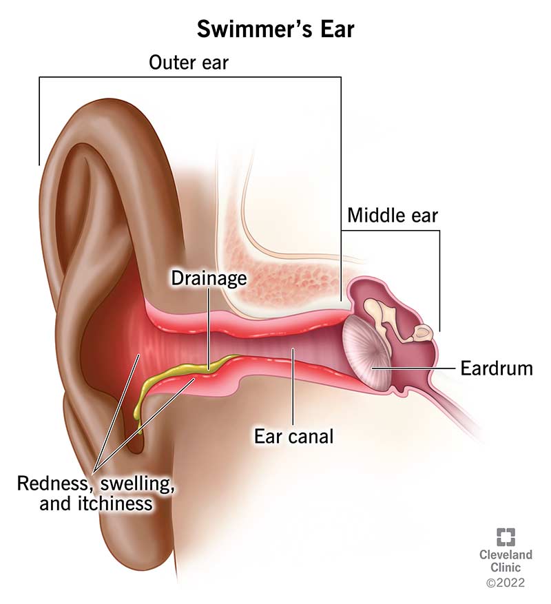 Swimmer’s ear symptoms include redness, swelling and itchiness in the outer ear (left) and drainage from the ear canal (center) in front of the eardrum.
