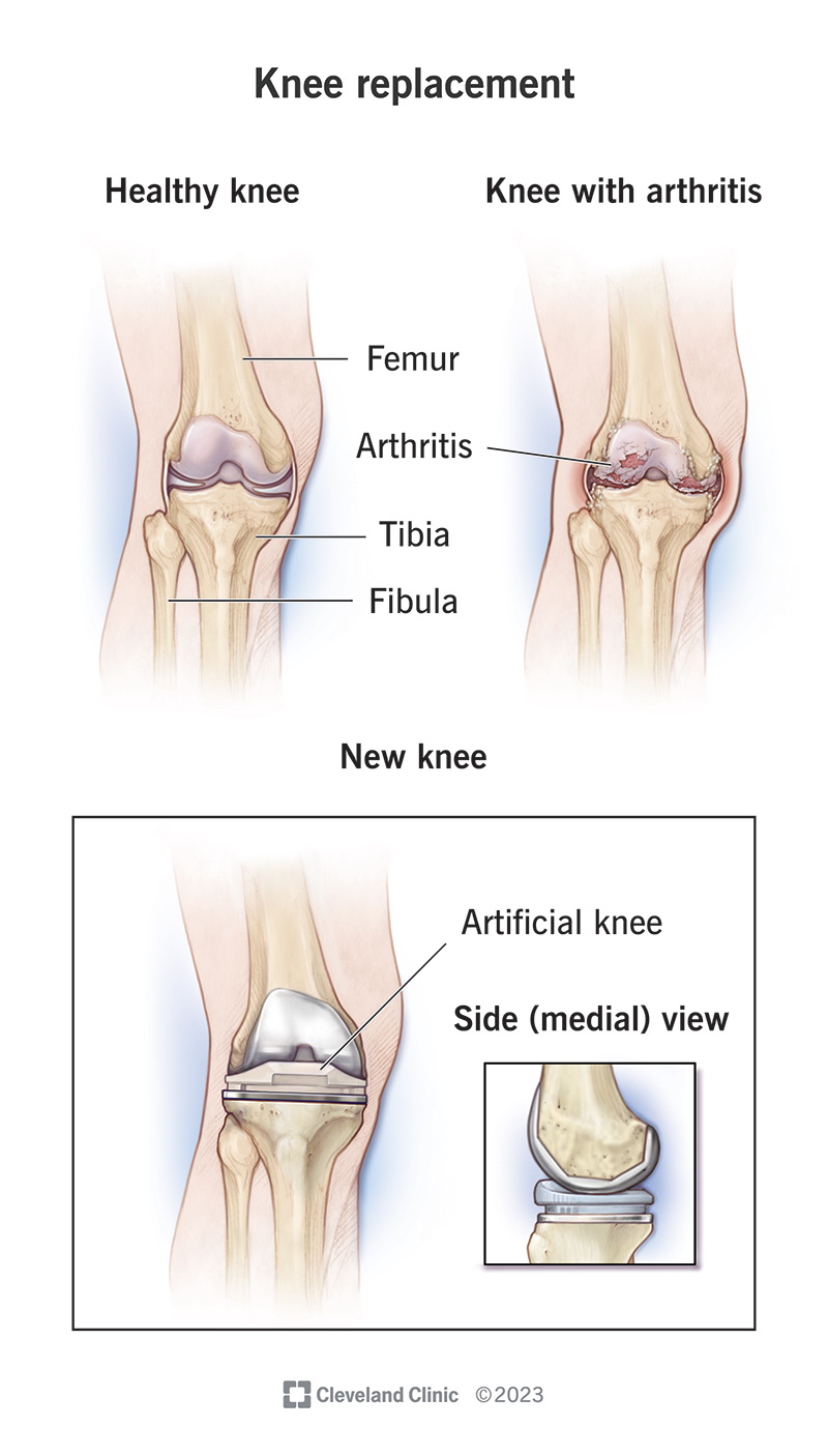 A healthy knee, a knee with arthritis and a knee after knee replacement surgery