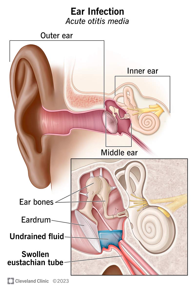 Fluid buildup inside the middle ear.