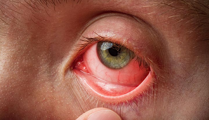 Pink Eye (Conjunctivitis): Symptoms, Treatment & Self-Care