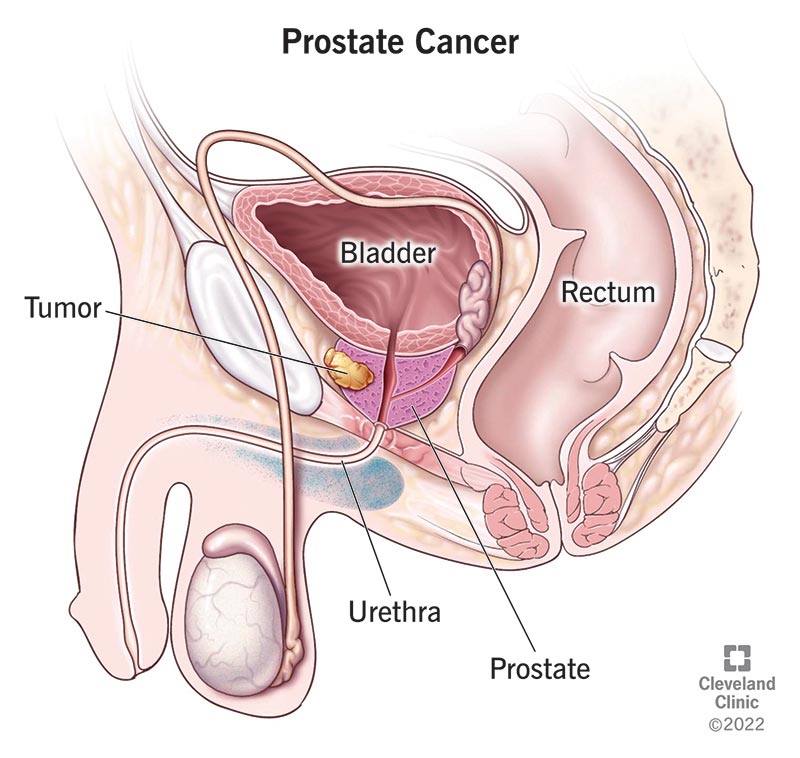 A tumor forming inside the prostate gland