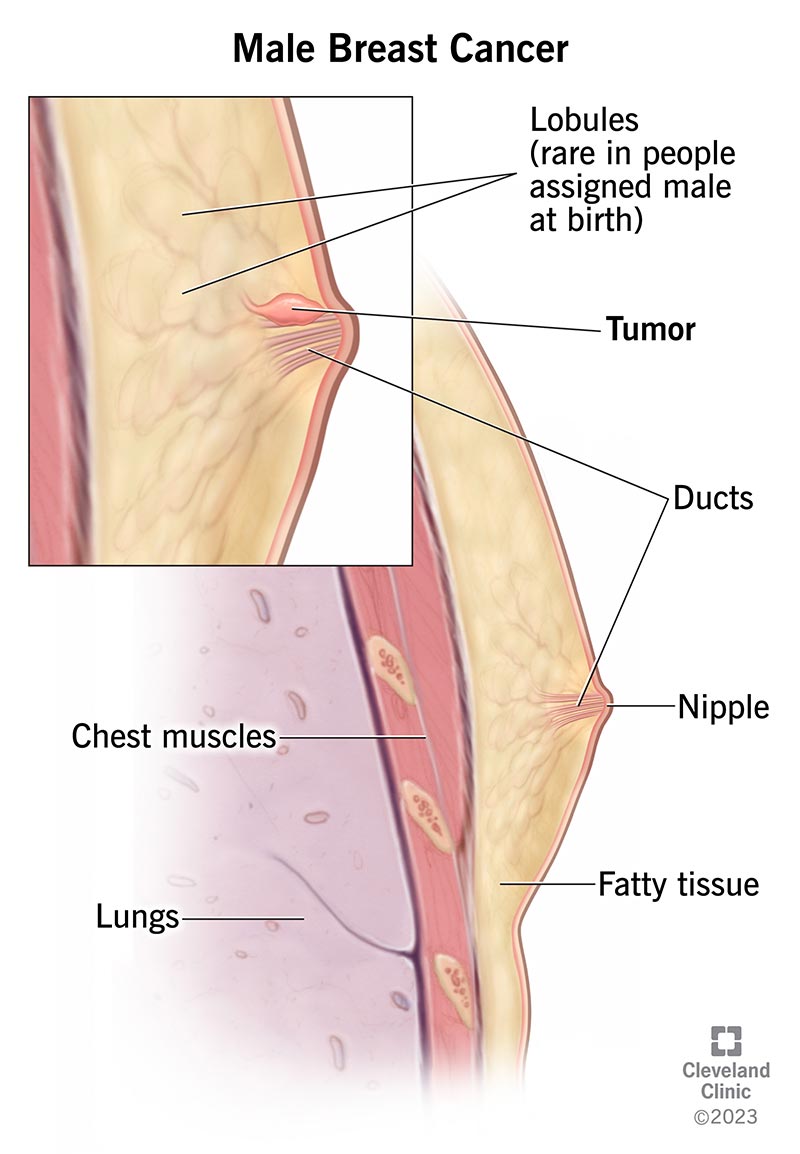 A tumor that’s formed in the lining of the breast ducts, near the nipple.
