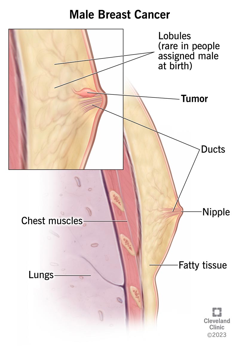 Armpit Lump - Causes, Consequences, Diagnosis and Treatment