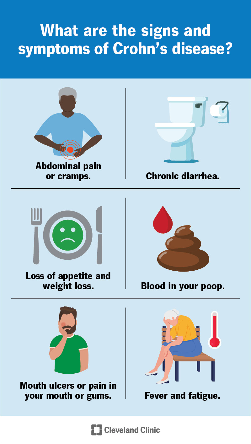 Signs and symptoms of Crohn’s disease.