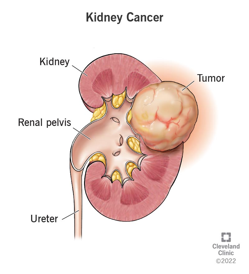 A kidney cancer tumor near the renal pelvis.