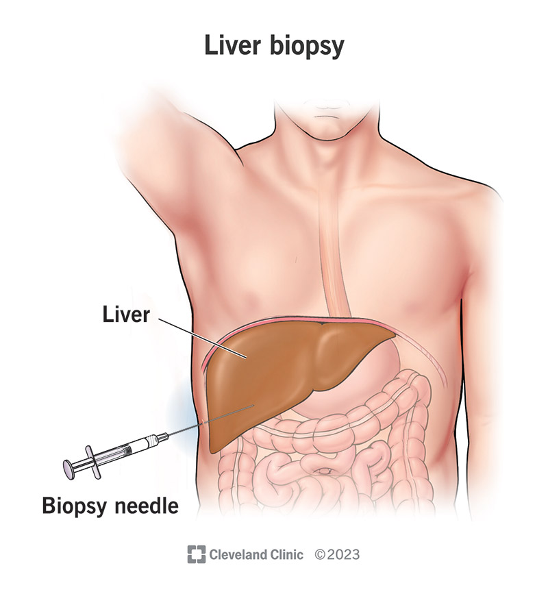 A healthcare provider can take a liver biopsy through a hollow needle.