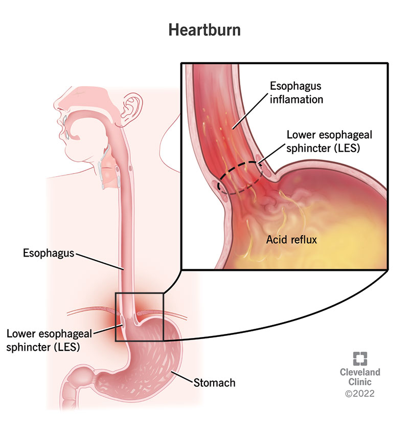 Heartburn occurs when acid from your stomach refluxes up into your esophagus.