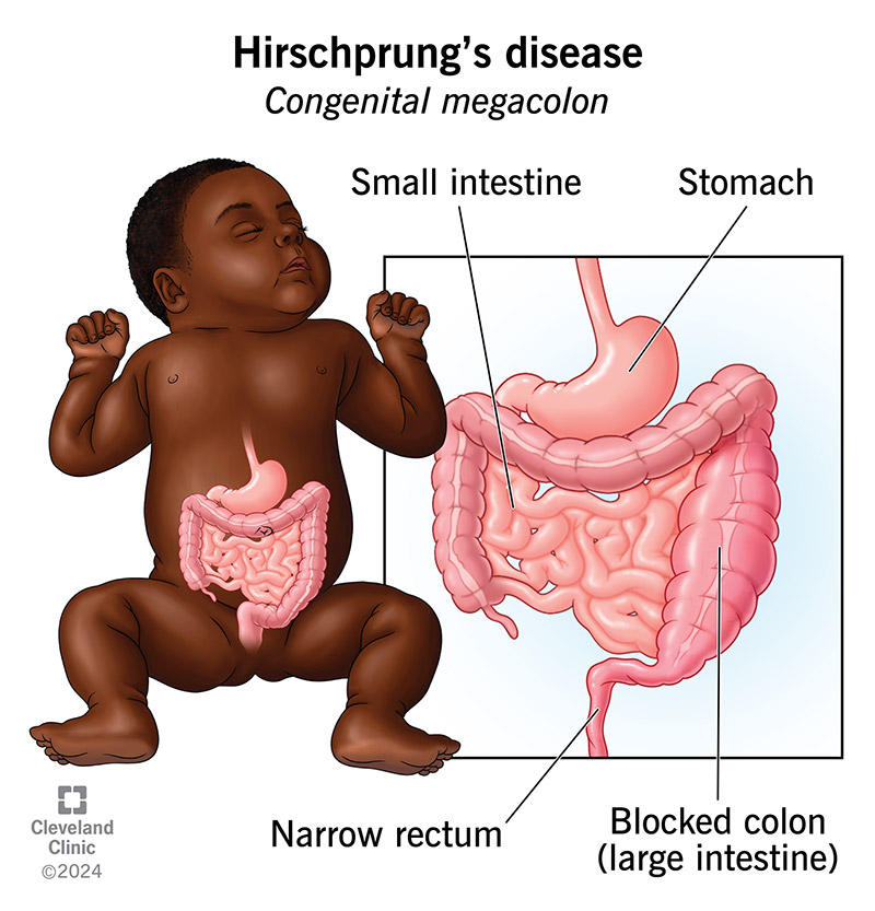 In Hirschsprung’s disease, the affected area of the large intestine contracts and narrows. Poop builds up in the colon.