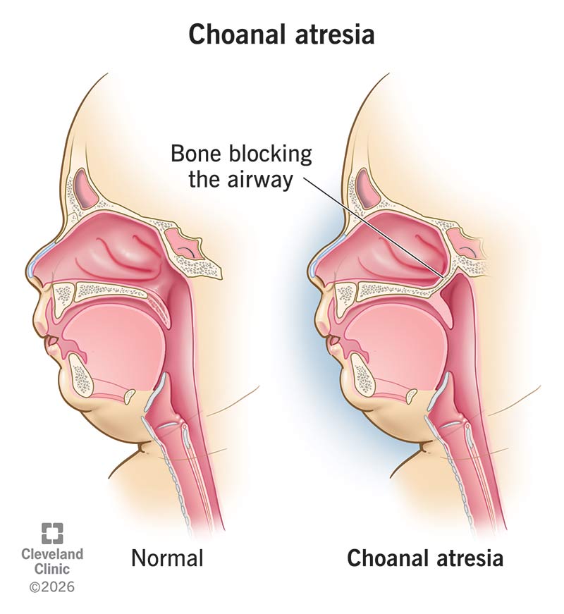 A nasal airway both with and without a blockage due to choanal atresia