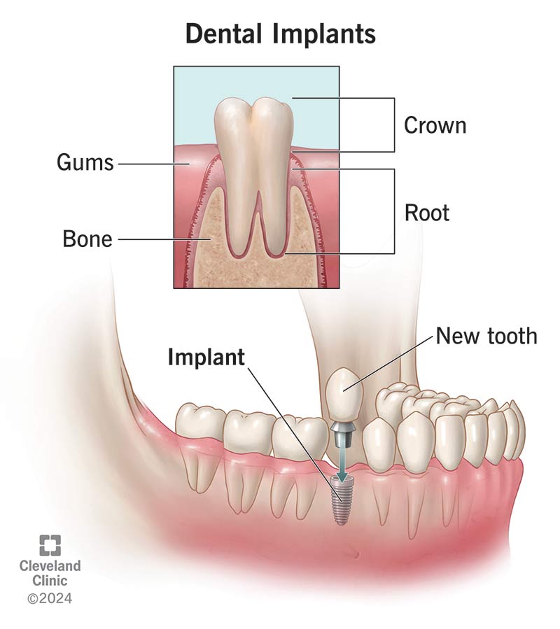 Root Canal Procedure