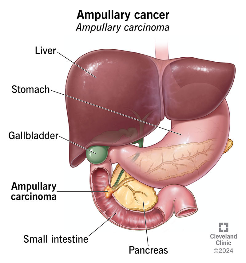 Ampullary carcinoma in the opening leading into the small intestine, where ducts from the liver and pancreas meet