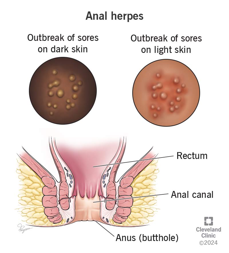 Anal herpes causes outbreaks of sores in your anal area