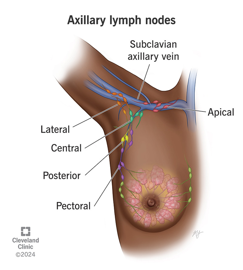 Axillary lymph node dissections involve removing lymph nodes from one or more group of lymph nodes in and around your armpit.