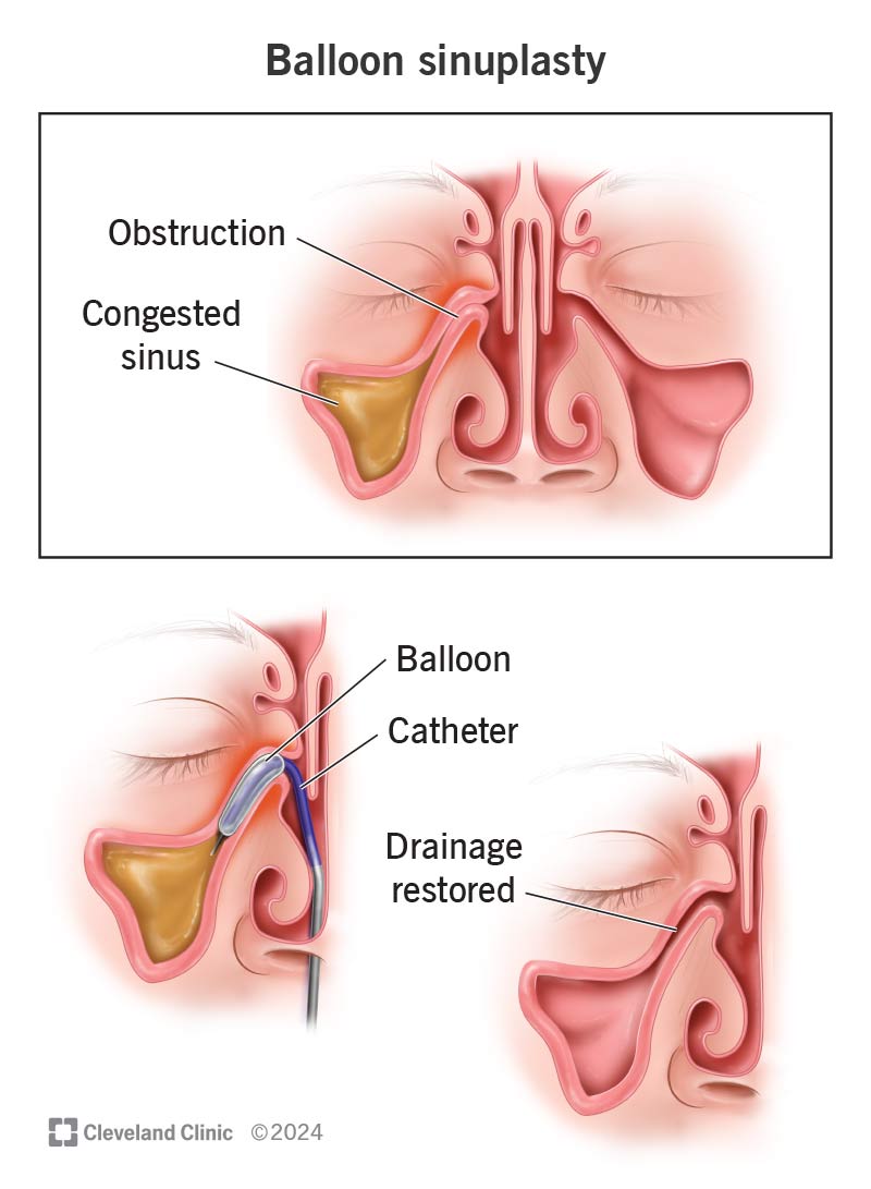 A balloon and catheter drain fluid from a congested sinus during sinuplasty