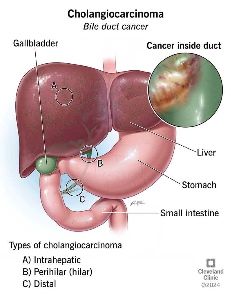 Locations within bile ducts where cholangiocarcinoma can form.