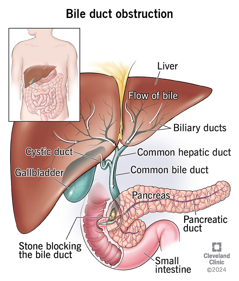 A gallstone creating an obstruction in the common bile duct