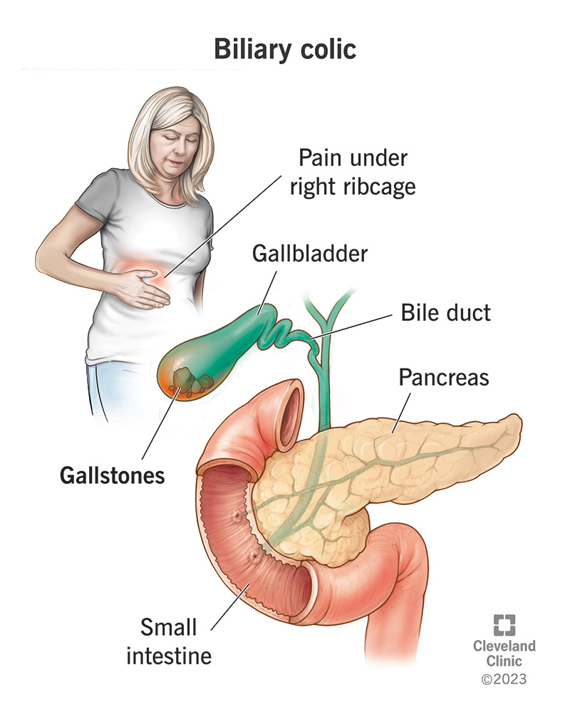 Biliary colic comes from your upper right abdomen, where your biliary organs are.