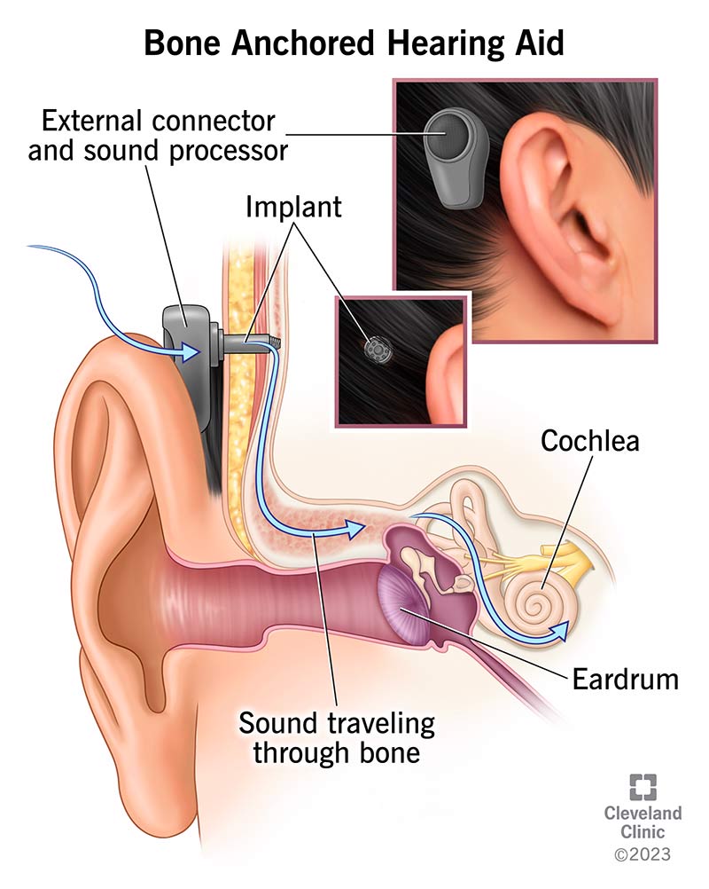 Bone anchored hearing aid moves soundwaves through processor and implant, stimulates bone, sends vibrations to cochlea.