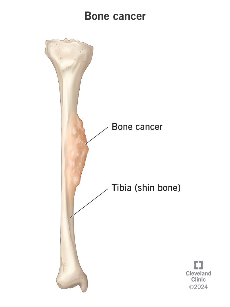 Bone cancer that has formed in the right tibia (shin bone)