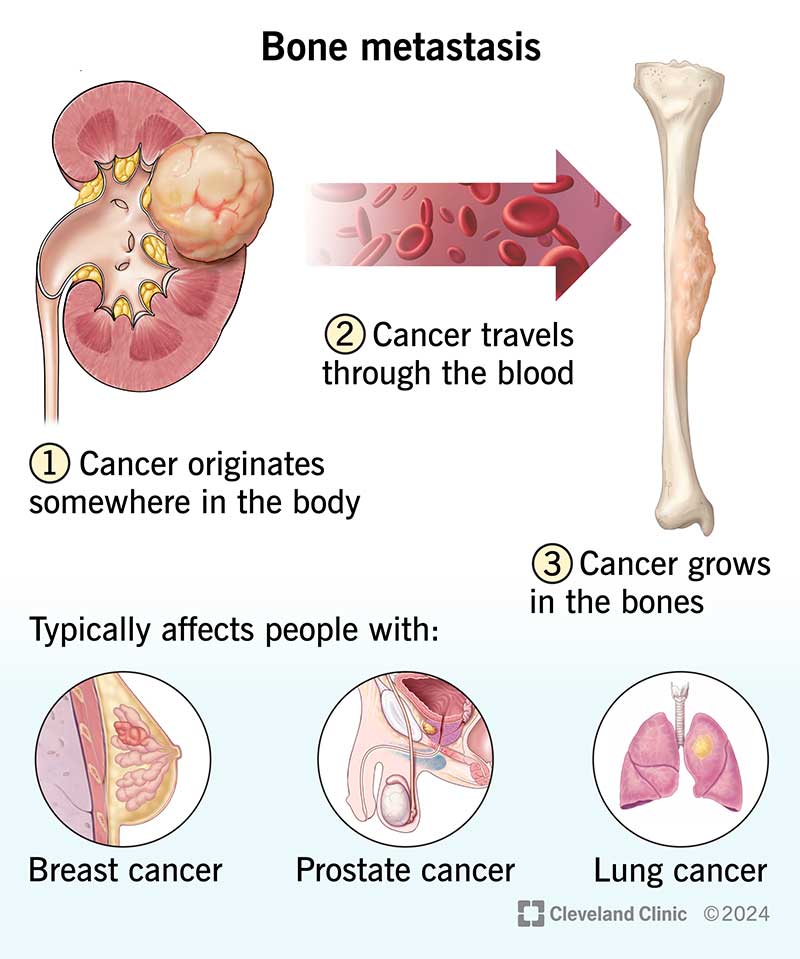 Bone metastasis is when cancer spreads to your bones, typically from cancer in your lungs, breasts or prostate.