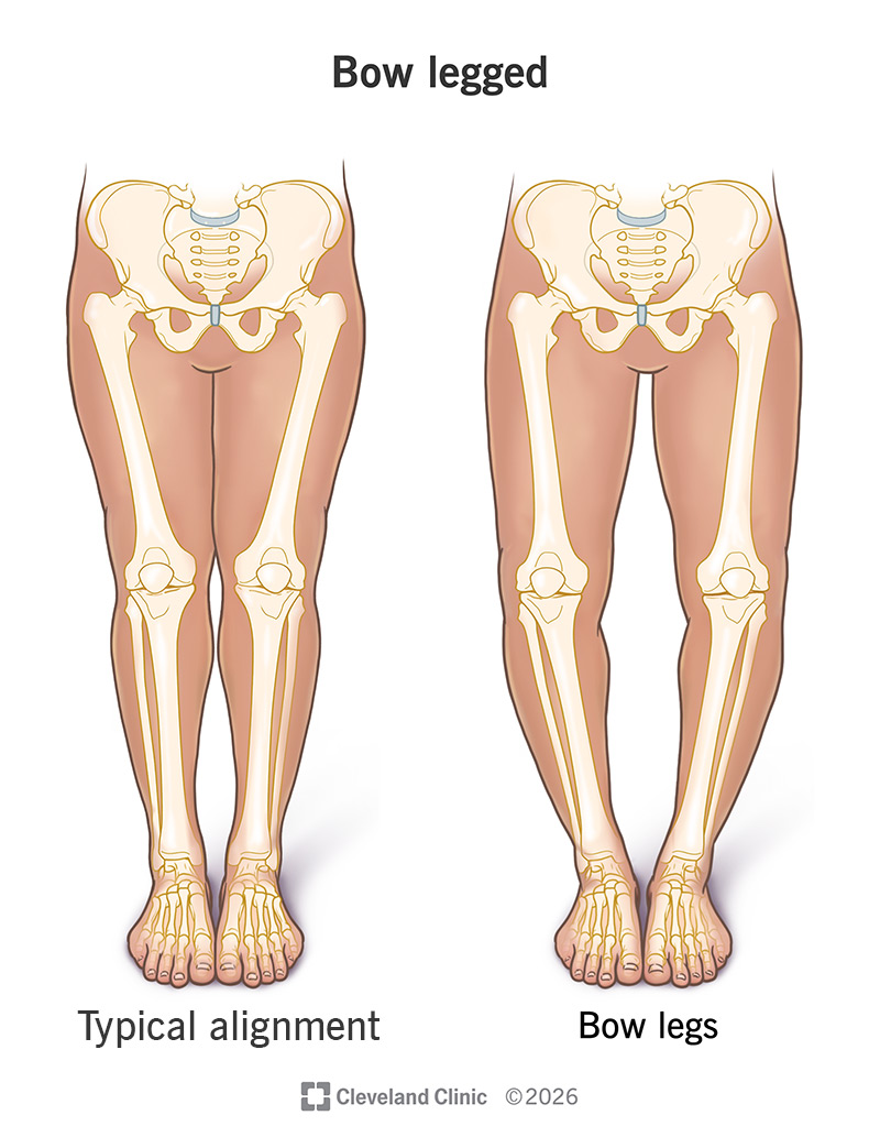 Comparison of typical leg alignment to bow legs
