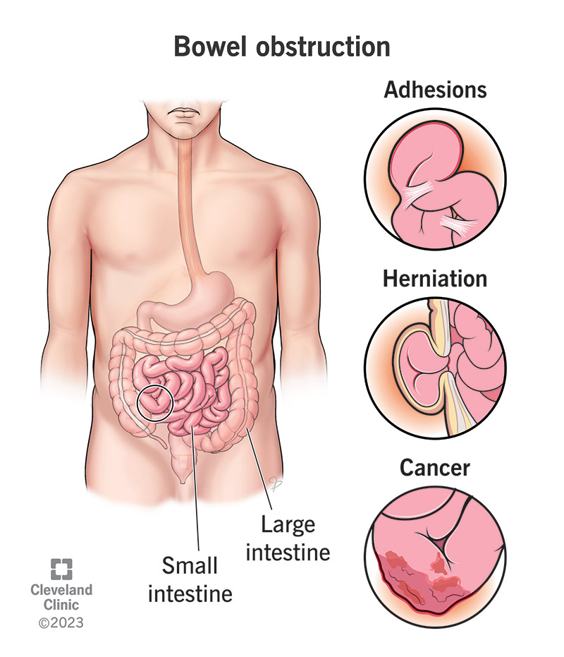 Bowel Obstruction: Signs & Symptoms, Causes, Treatment