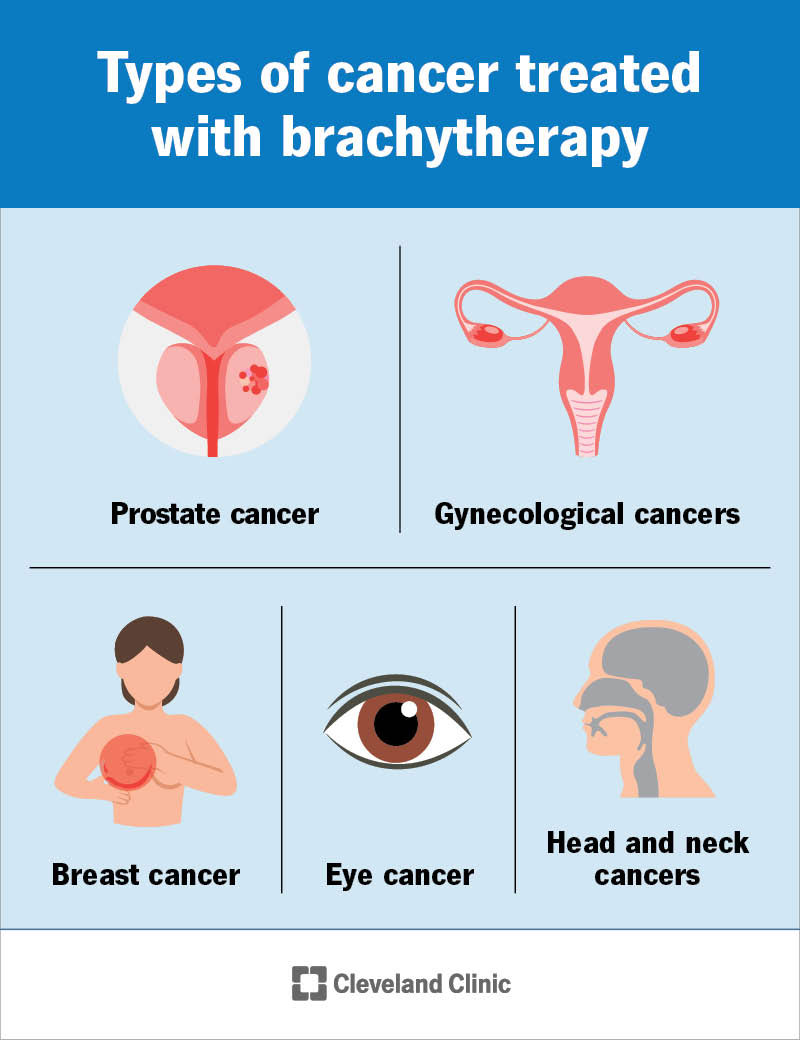 Types of cancer treated with brachytherapy, or internal radiation