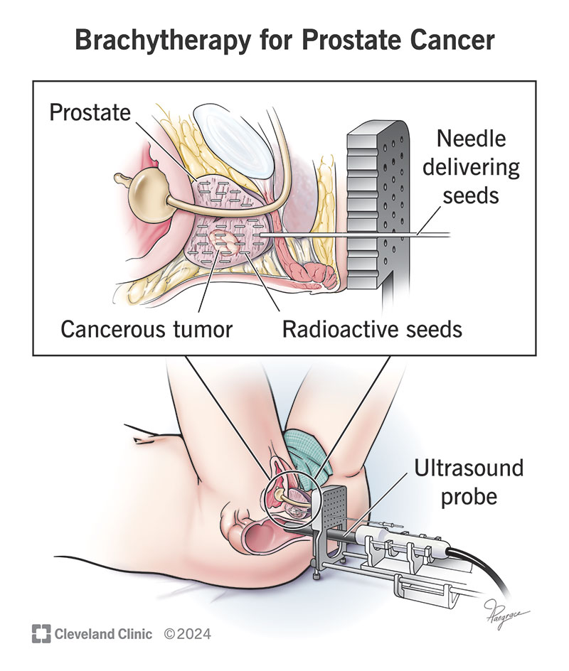 Brachytherapy for prostate cancer uses an ultrasound probe to place radioactive seeds in a tumor in your prostate (inset)