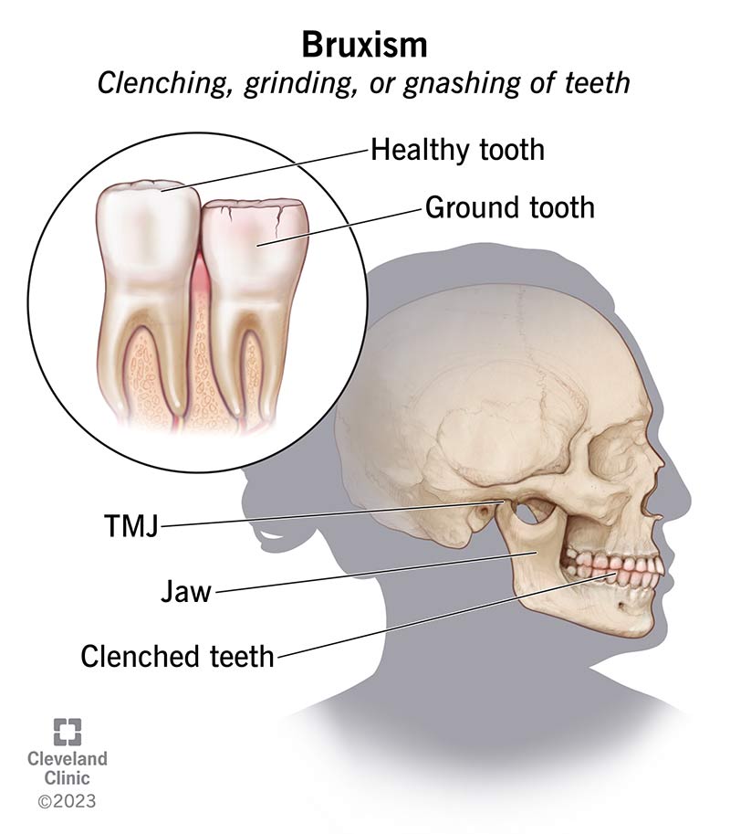 Healthy tooth vs. tooth damaged by bruxism (clenching, grinding or gnashing).