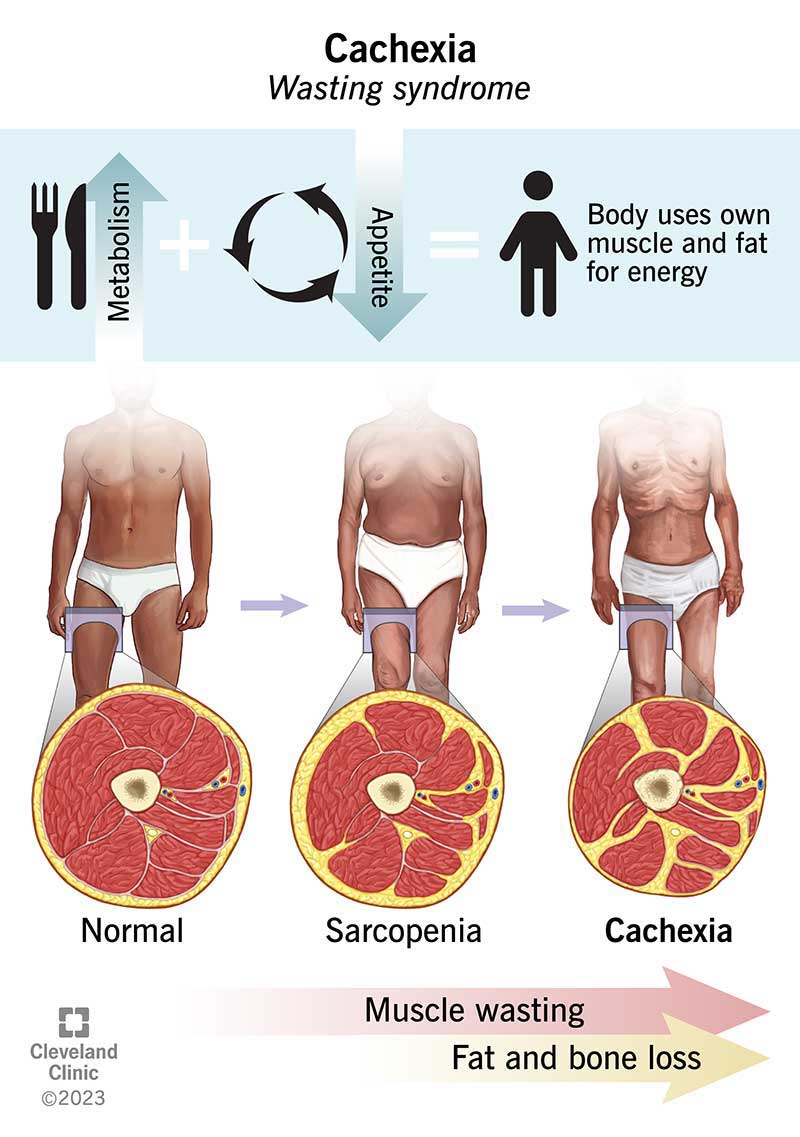 Cachexia (far right) happens when you have a life-threatening chronic illness that makes your body lose muscle, fat and bone