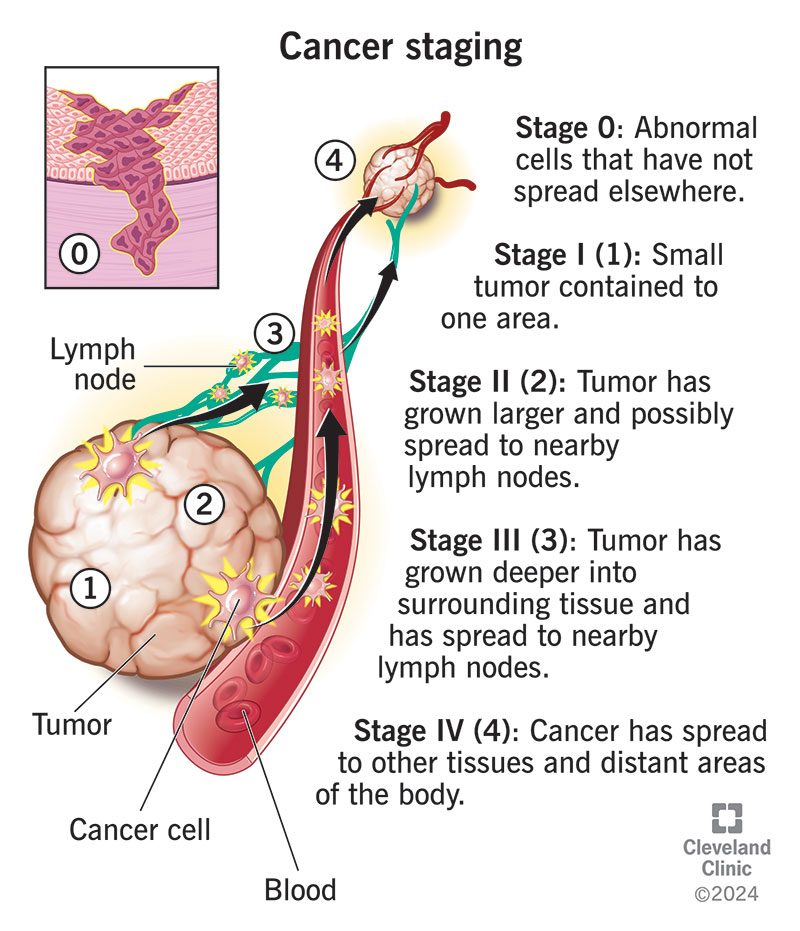 Cancer staging 0 - 4; cancer cells grow and multiply, spreading to surrounding tissue, lymph nodes, blood and distant areas.