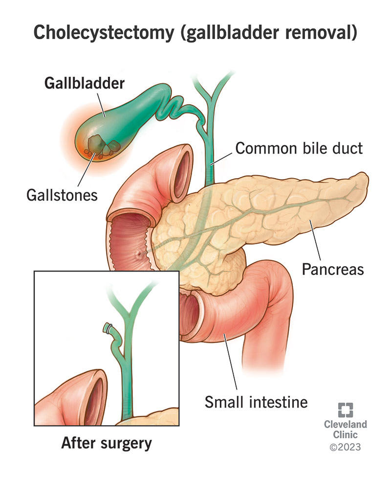 Removing your gallbladder won’t prevent bile from flowing to your intestine.