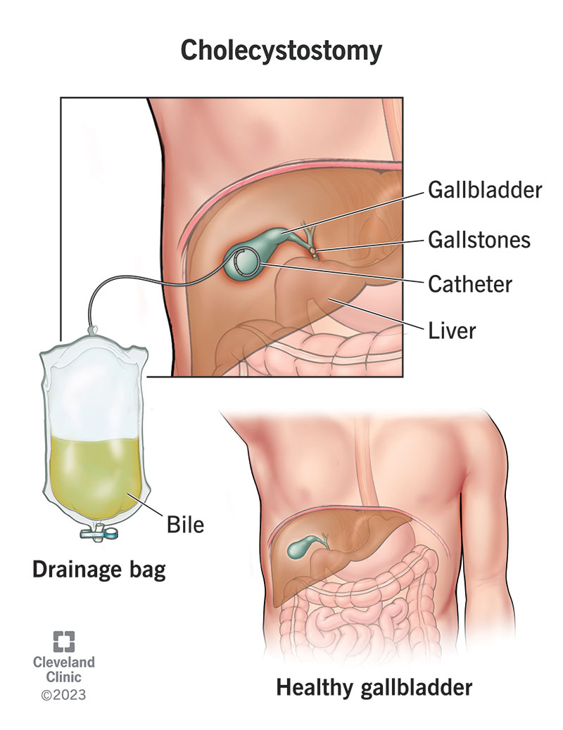 A cholecystostomy inserts a catheter into your gallbladder to drain excess bile.