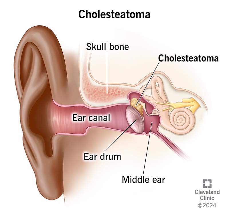 A cholesteatoma growth in the middle ear