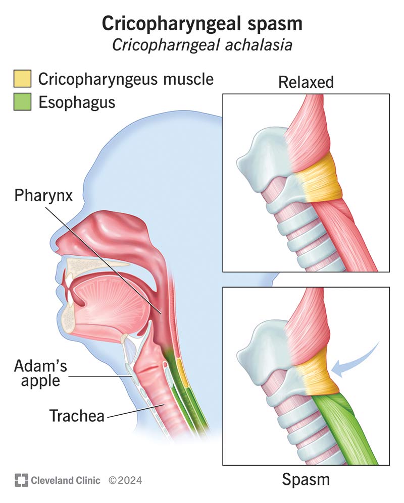 Cricopharyngeal spasm vs. relaxed cricopharyngeal muscle