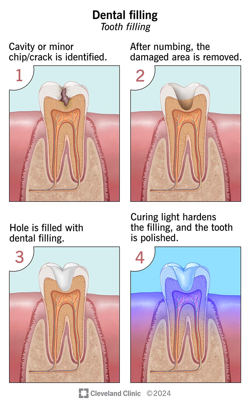 The steps involved in a dental filling procedure