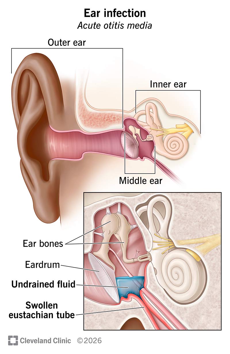 Anatomy of the ear with ear infection, with undrained fluid in middle ear trapped by a swollen eustachian tube